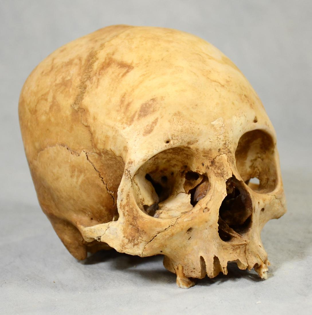Real Human Skull  European Medical Use sans Lower Jaw (1 of 5)