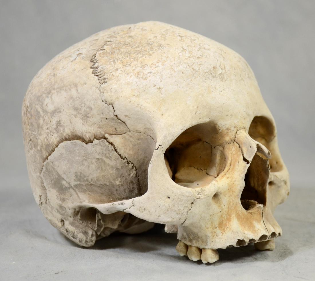Lg Genuine Human Skull  Medical Use sans Lower Jaw, (1 of 3)
