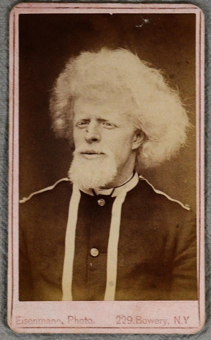 Rare Circus Freak Albino Side Show Eisenmann CDV Photo (1 of 1)