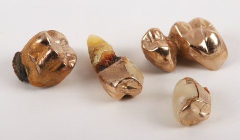 Gold Fillings