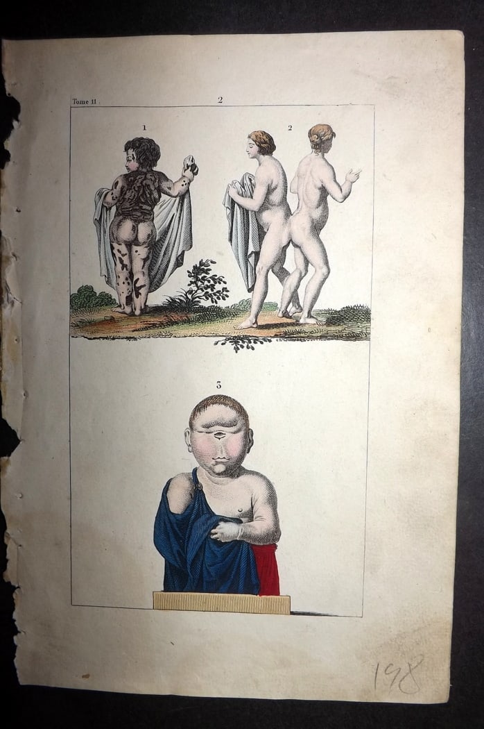 Buffon & Lacepede 1819 Hand Col Medical Print. Conjoined Twins & Skin Diseases: Hand Colored Etching with Engraving Published 1819-22, Paris for "Oeuvres compl?tes de Buffon" by the Comte de Buffon and Bernard Germain de Lacepede. Paper Size: 8 x 5 inch (20 x 13cm) Good Condition