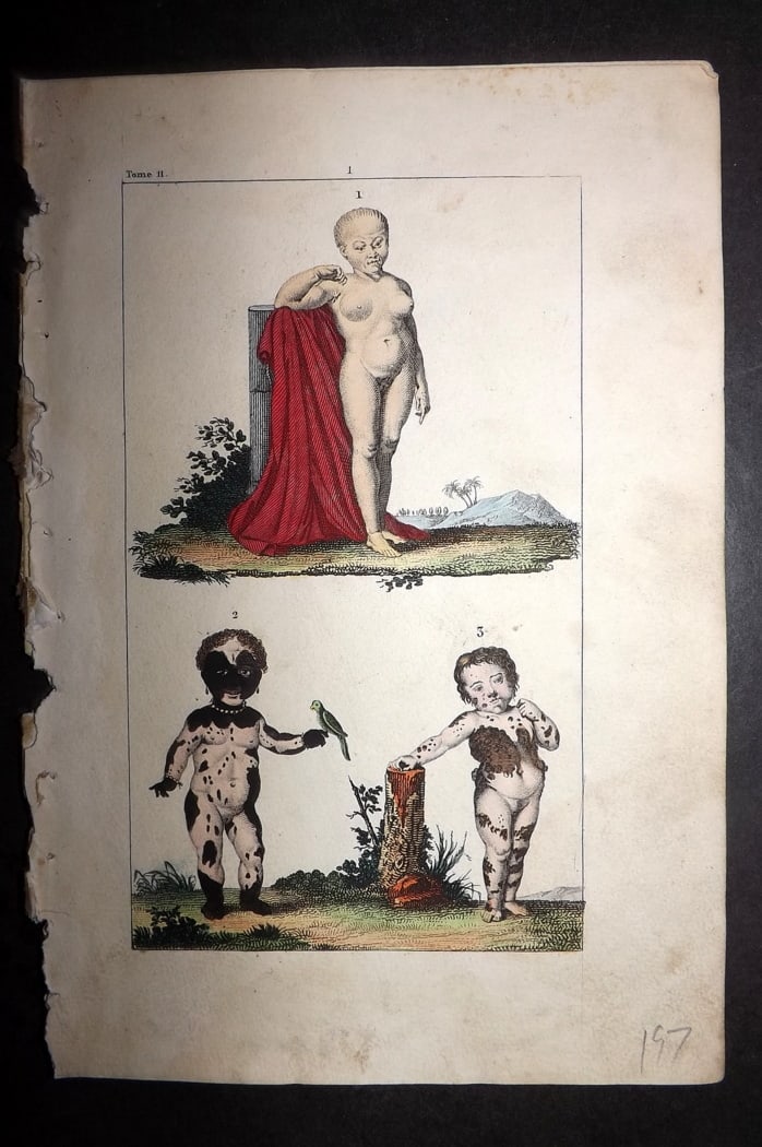 Buffon & Lacepede 1819 Hand Col Medical Print. Skin Diseases: Hand Colored Etching with Engraving Published 1819-22, Paris for "Oeuvres compl?tes de Buffon" by the Comte de Buffon and Bernard Germain de Lacepede. Paper Size: 8 x 5 inch (20 x 13cm) Good Condition