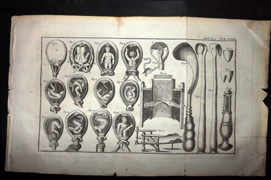 Heister, Lorenz 1743 Folio Medical Print. Surgery 33: Folio Copper Plate Published 1743, London for "A General System of Surgery" by Lorenz Heister. First English Edition. Folds as issued. Rare. Paper Size: 16 x 10 inch (40 x 25cm) A couple of margin tea