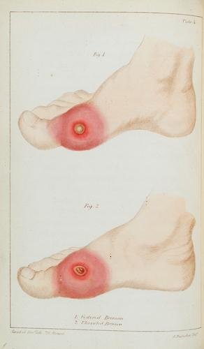 Durlacher. A Treatise on Corns,