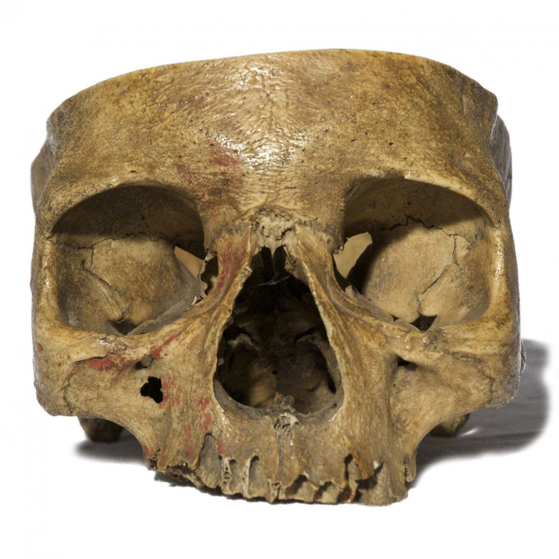 Genuine 19th Century Human Skull Medical Study (1 of 8)