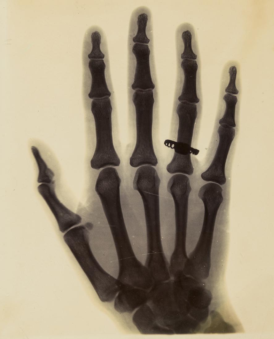 Teall (Sir Jethro) X-ray print of Alvina Bertram C (1 of 1)