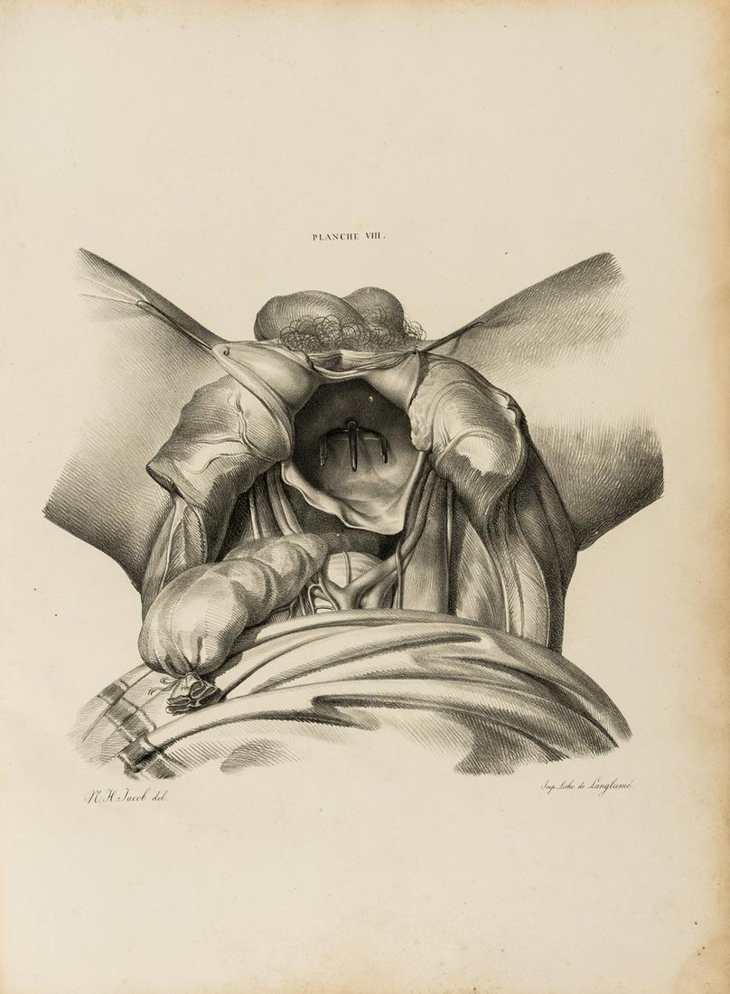 Lithotomy.- Dupuytren (Guillaume) Mémoire sur une Maniere Nouvelle de pratiquer l'Opé (1 of 1)