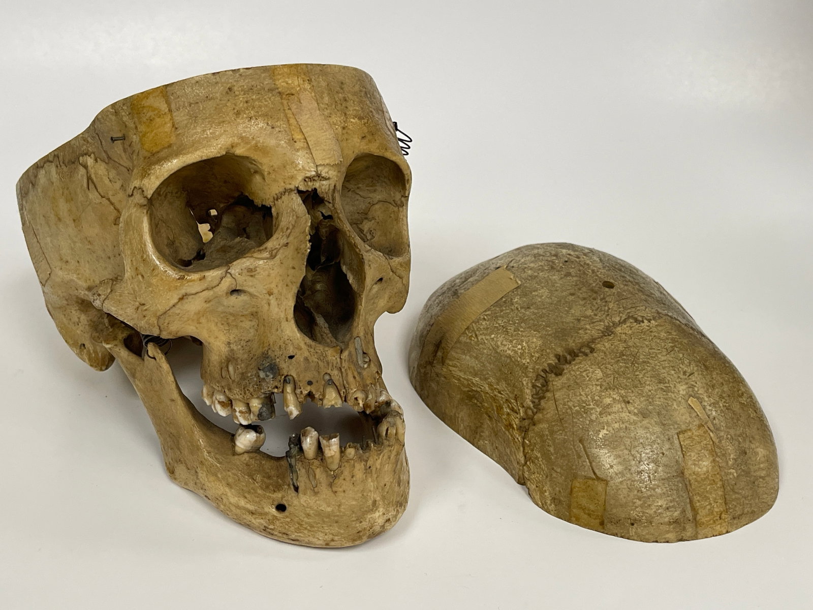 AUTHENTIC HUMAN SKULL SPECIMEN: AUTHENTIC HUMAN SKULL SPECIMEN FOR MEDICAL OR INSTRUCTIONAL USE. A REAL HUMAN CRANIUM WITH REMOVEABLE CALVARIUM AND ARTICULATED JAW, FITTED WITH SPRINGS, PINS AND HARDWARE.INCREASINGLY RARE TEACHING