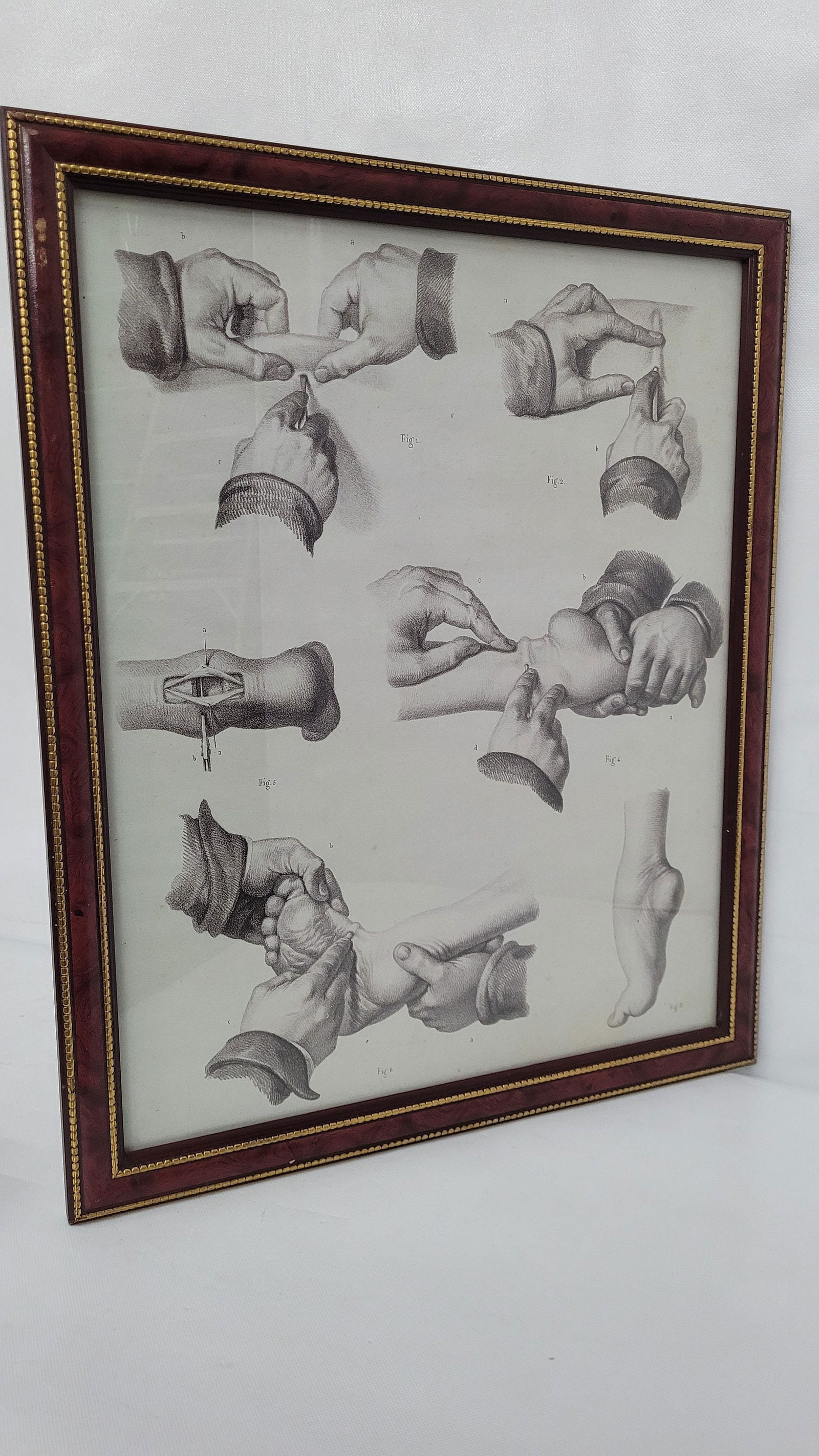 Vintage framed print foot surgery medical office display decor illustration (1 of 4)