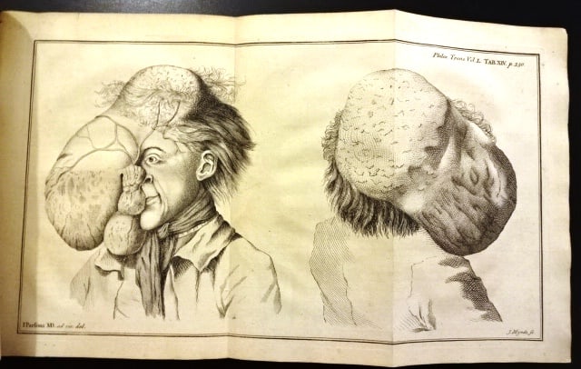 1757 Medical Extract of a Large Head Tumor: A large folding engraving showing an "Extraordinary Tumors upon the head of a Labouring man", along with the accompanying article, extracted from Philosophical Transactions, printed at London, 1757. F