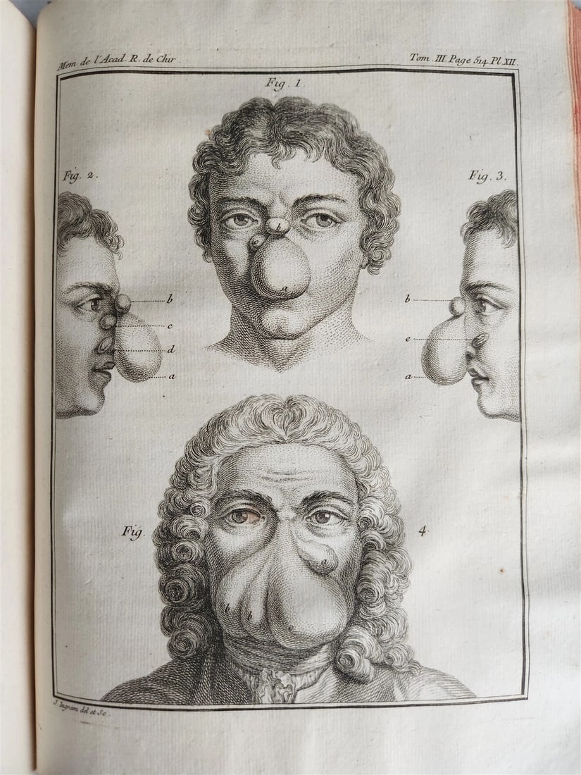 1753 SURGERY ANATOMY ILLUSTRATED antique Memoires l'Academie Royale de Chirurgie: Title: 1753 SURGERY ANATOMY ILLUSTRATED antique Memoires l'Academie Royale de Chirurgie Description: Memoires de l'Academie Royale de Chirurgie Volume II Paris; 1753 Illustrated with engraved plates.