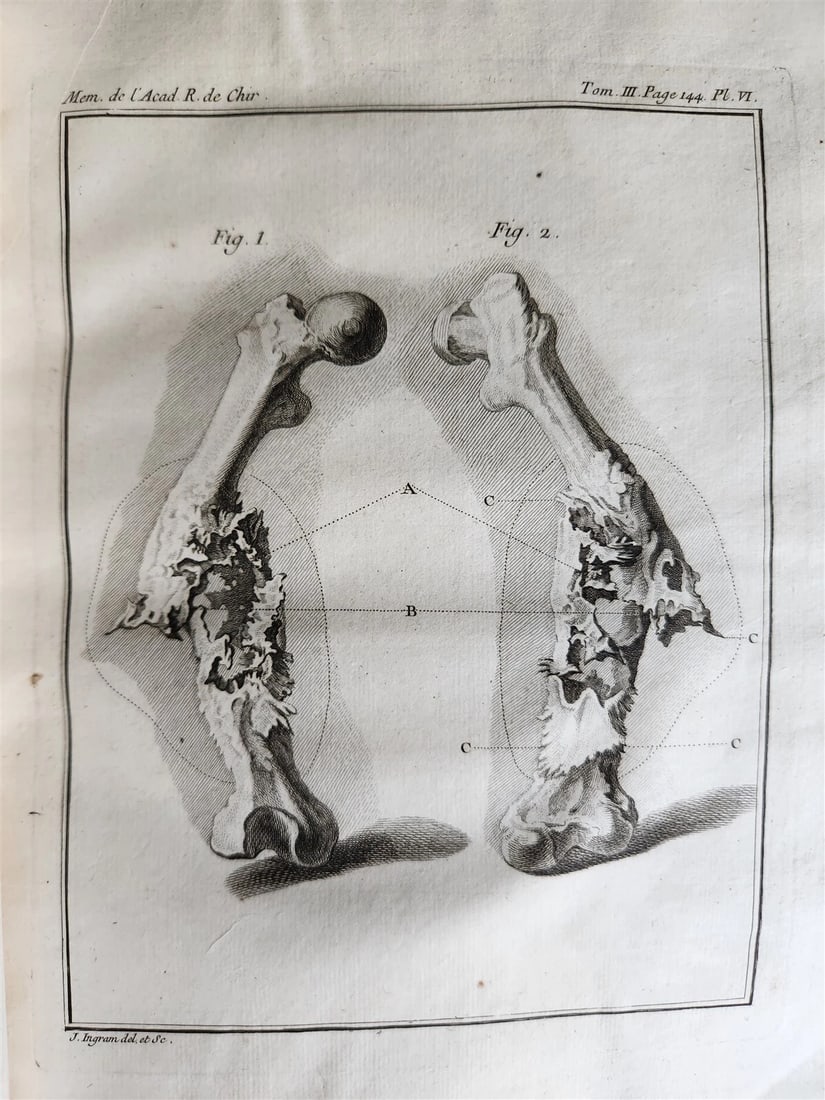 1753 SURGERY ANATOMY ILLUSTRATED antique Memoires l'Academie Royale de Chirurgie - 7
