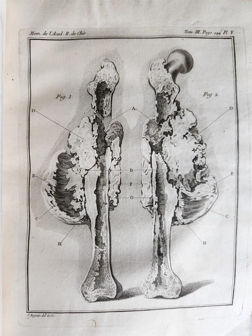1753 SURGERY ANATOMY ILLUSTRATED antique Memoires l'Academie Royale de Chirurgie - 8