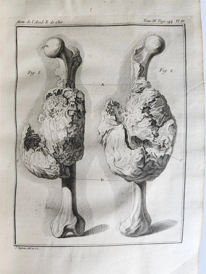 1753 SURGERY ANATOMY ILLUSTRATED antique Memoires l'Academie Royale de Chirurgie - 9