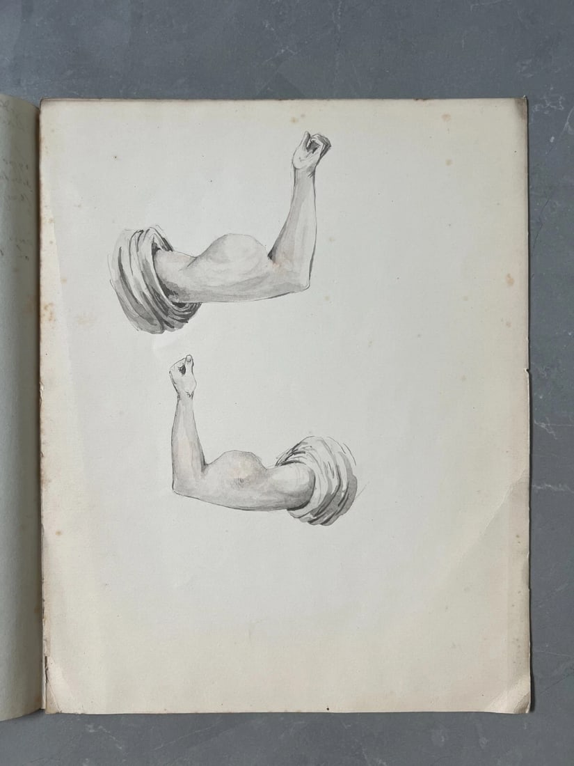 Antique Drawing Original Medecin, Doctor, Lipoma 19th century 1840 - 2