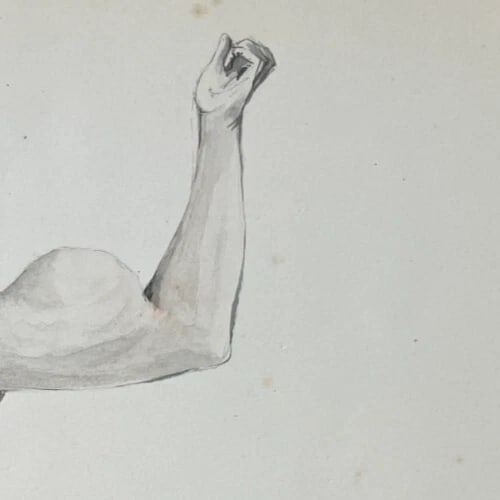 Antique Drawing Original Medecin, Doctor, Lipoma 19th century 1840 - 5