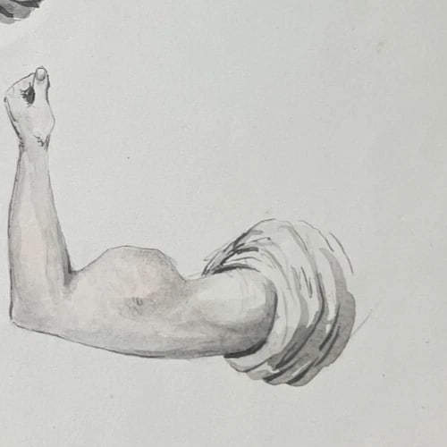 Antique Drawing Original Medecin, Doctor, Lipoma 19th century 1840 - 7