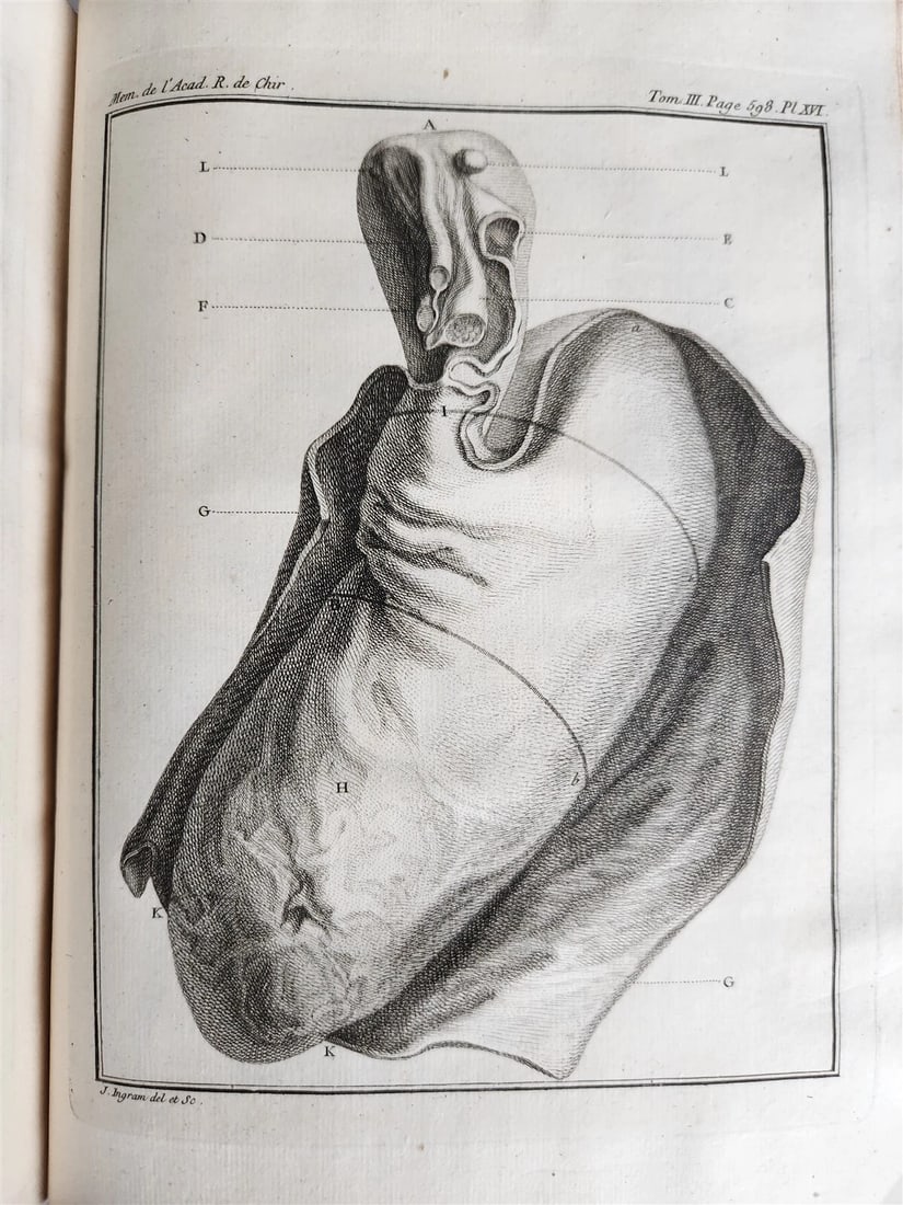 1753 SURGERY ANATOMY ILLUSTRATED antique Memoires l'Academie Royale de Chirurgie - 17