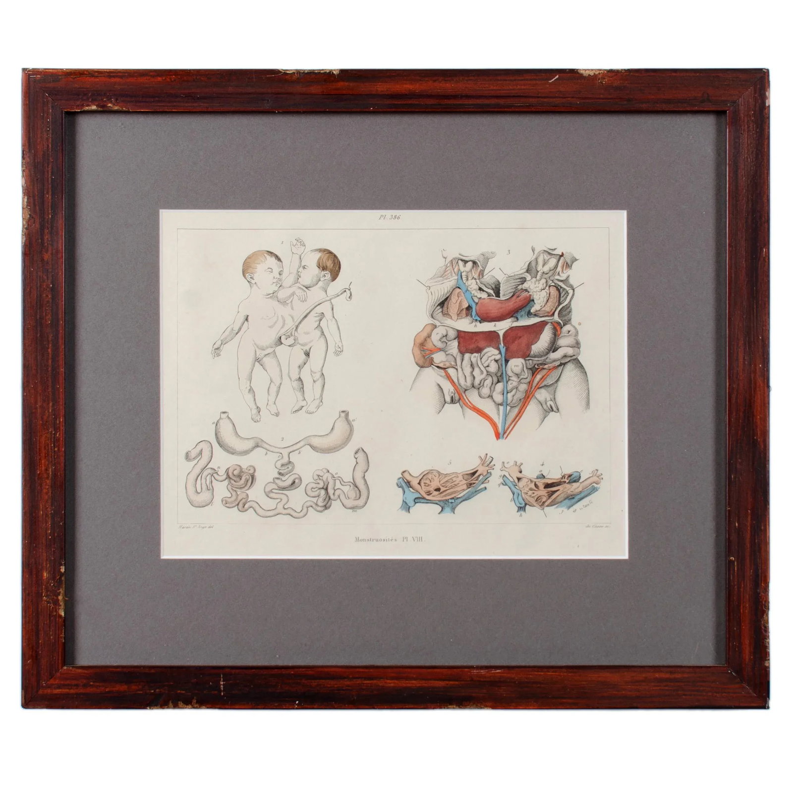 Monstruosites, Engravings From Isidore Geoffrey Sainte-Hilaire, Paris C. 1832 - Set of 4 - 6