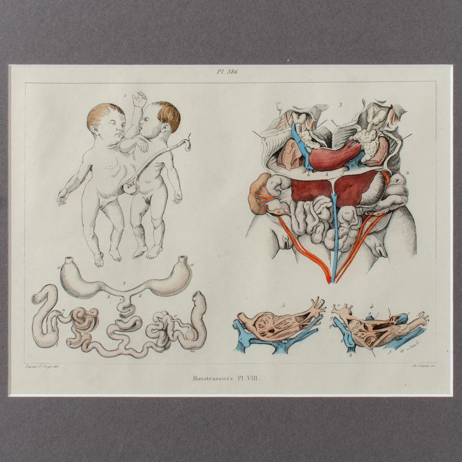 Monstruosites, Engravings From Isidore Geoffrey Sainte-Hilaire, Paris C. 1832 - Set of 4 - 7