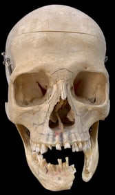 Early Medical Oddity 17 5/8 Brow Circumference Unusually Shaped HUMAN SKULL