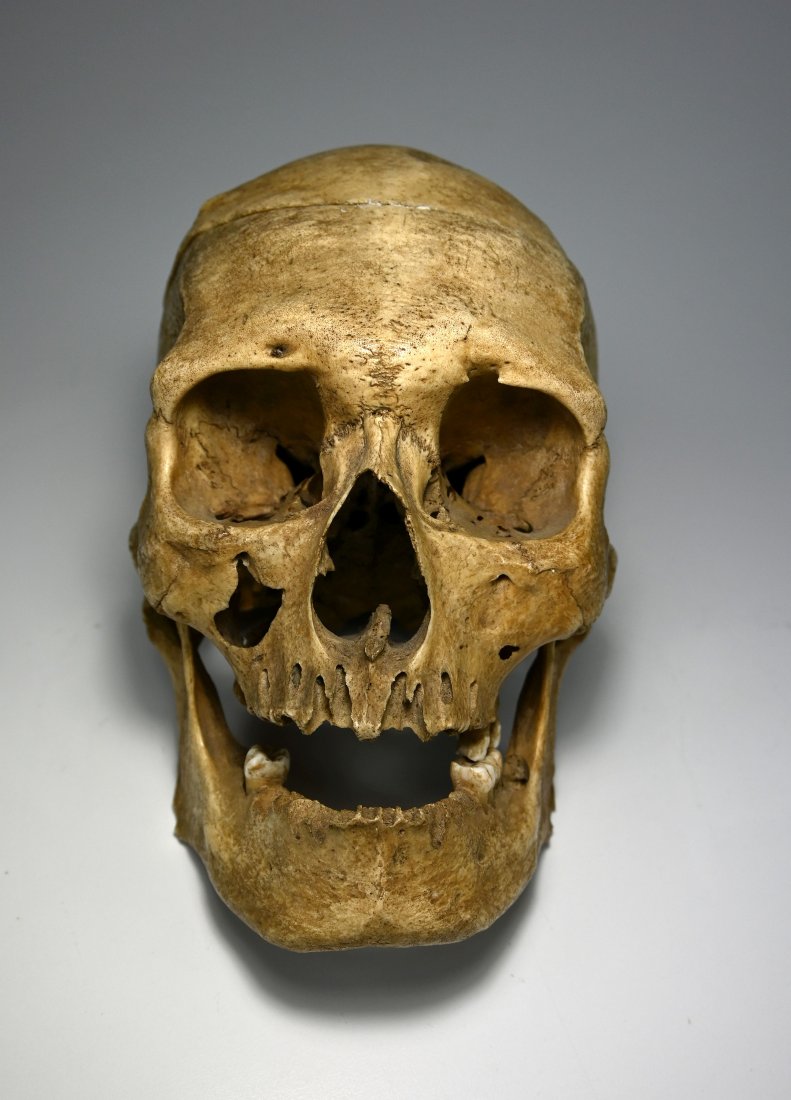 Antique Human Skull with Medical Abnormalities (1 of 15)