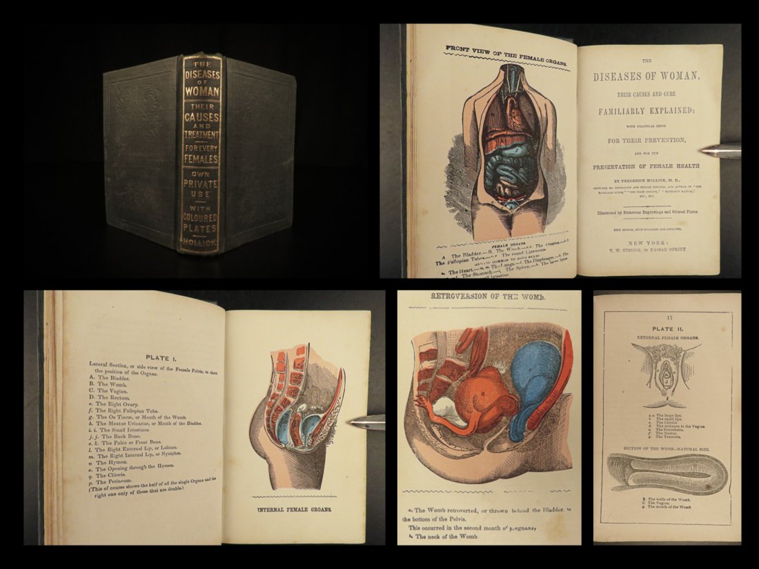1855 Diseases of Women Medicine Female Health Pregnancy Midwifery Sexuality: 1855 Diseases of Women Medicine Female Health Pregnancy Midwifery Sexuality Frederick Hollick was a controversial American physician, educator of sexual health and author of works regarding womens dis