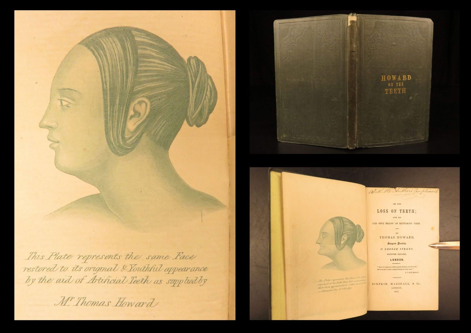 1852 – On the Loss of Teeth | Early Dentistry, Medicine & Tooth Surgery: On the Loss of Teeth by Thomas Howard is a relatively unknown 19th-century dentistry manual. Written in Victorian London, this book provides dentists on the anatomy of teeth, the formation of enamel,