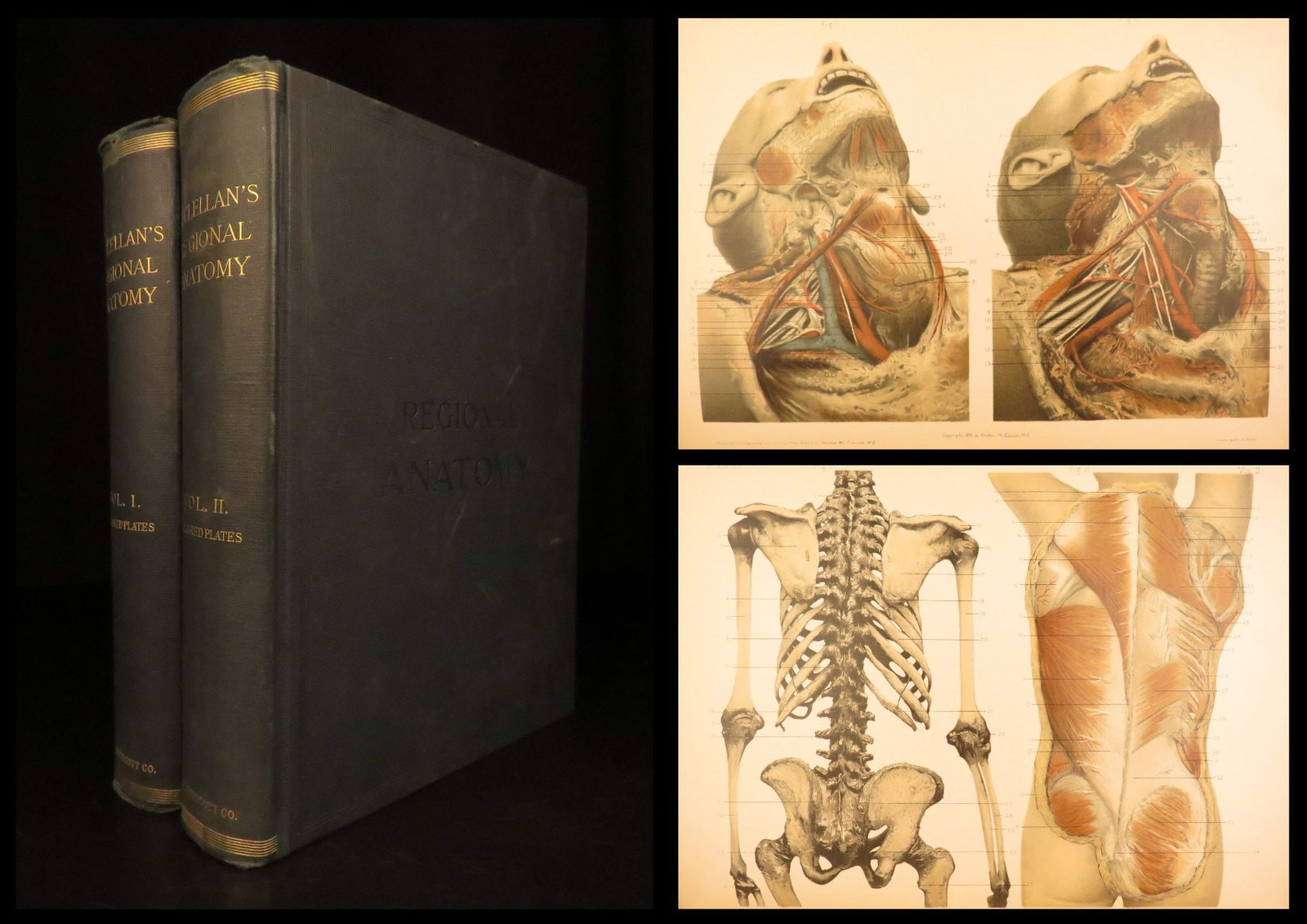 1891 – Regional Anatomy – McClellan | Illustrated Medicine & Surgery, First Edition: Regional Anatomy in Its Relation to Medicine and Surgery is the best-known work of American anatomist George McClellan. Published in 1891-1892, this monumental two-volume study examines the human body