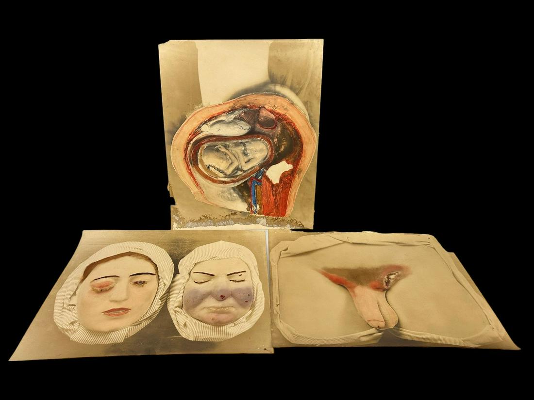 (3) Very Early Hand Tinted Large Autopsy Photographs Teaching Venereal Disease (1 of 11)