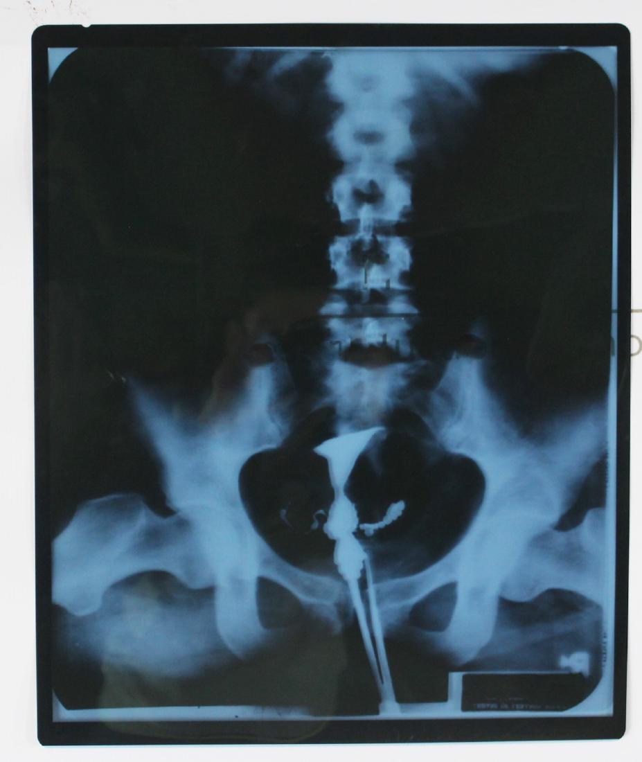 Marilyn Monroe X-Ray of Pelvis (1 of 2)