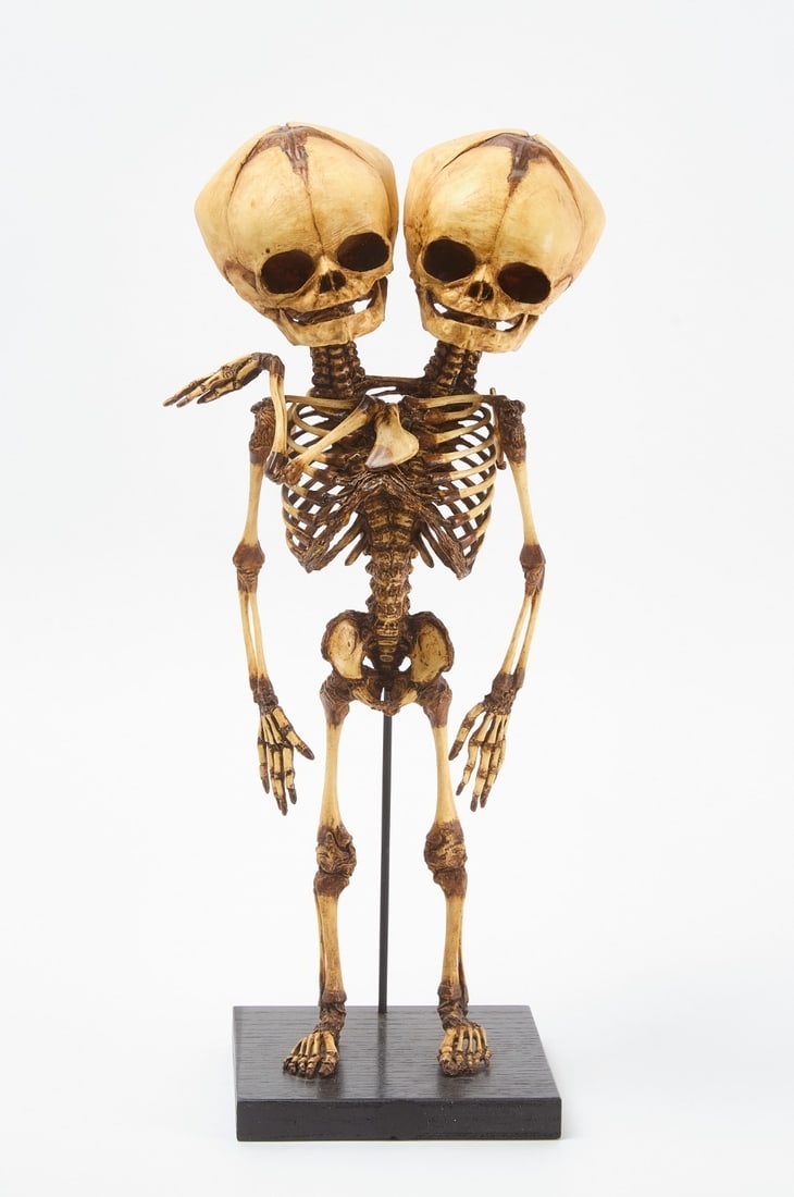 Conjoined Twin Mounted Fetal Skeleton Replica: Replica siamese or coinjoin fetal twin mounted skeleton.H 16 in. without mount W 7 1/2 in .