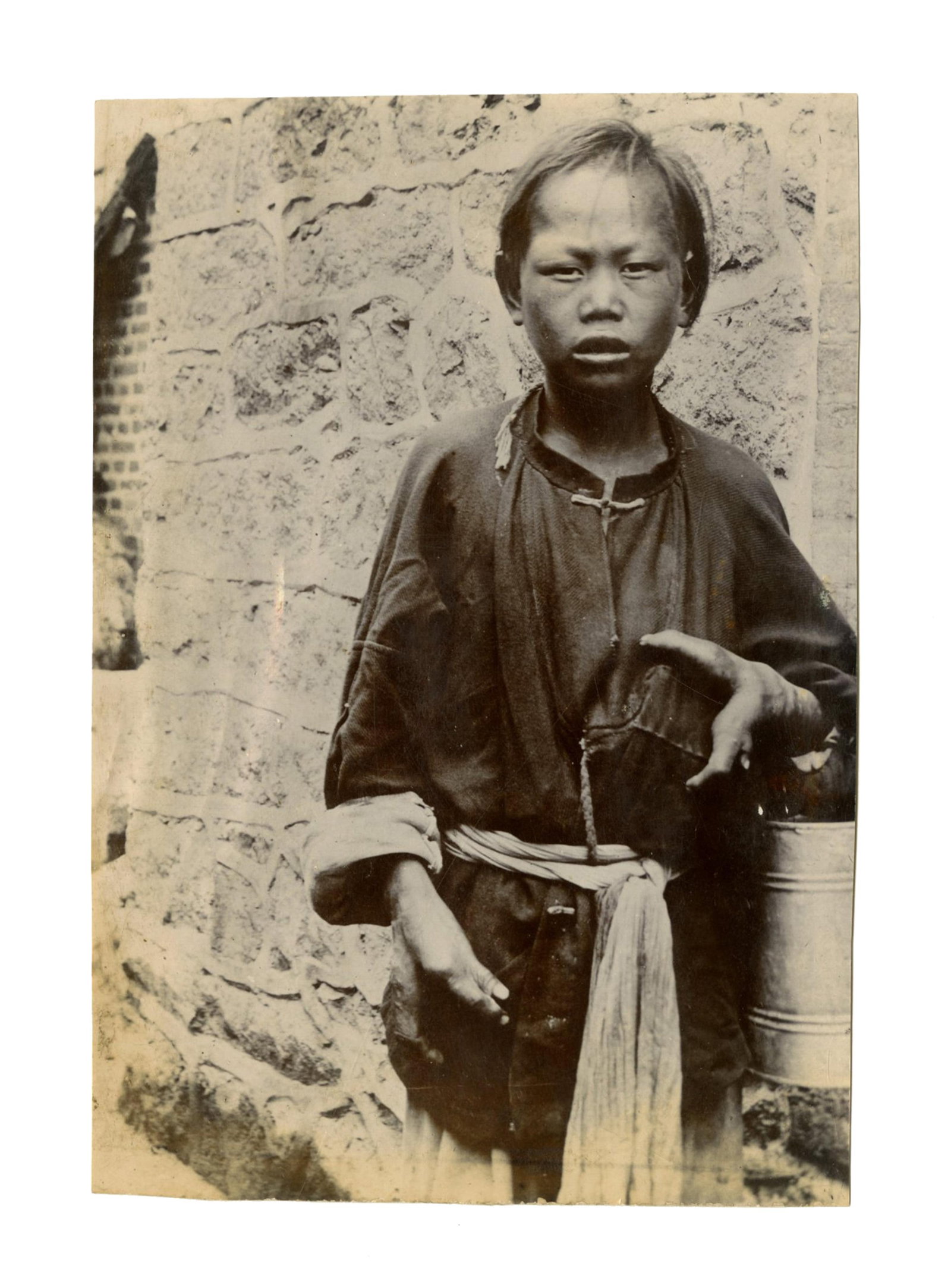 Rare Photograph of Young Boy With Ectrodactyly (1 of 2)