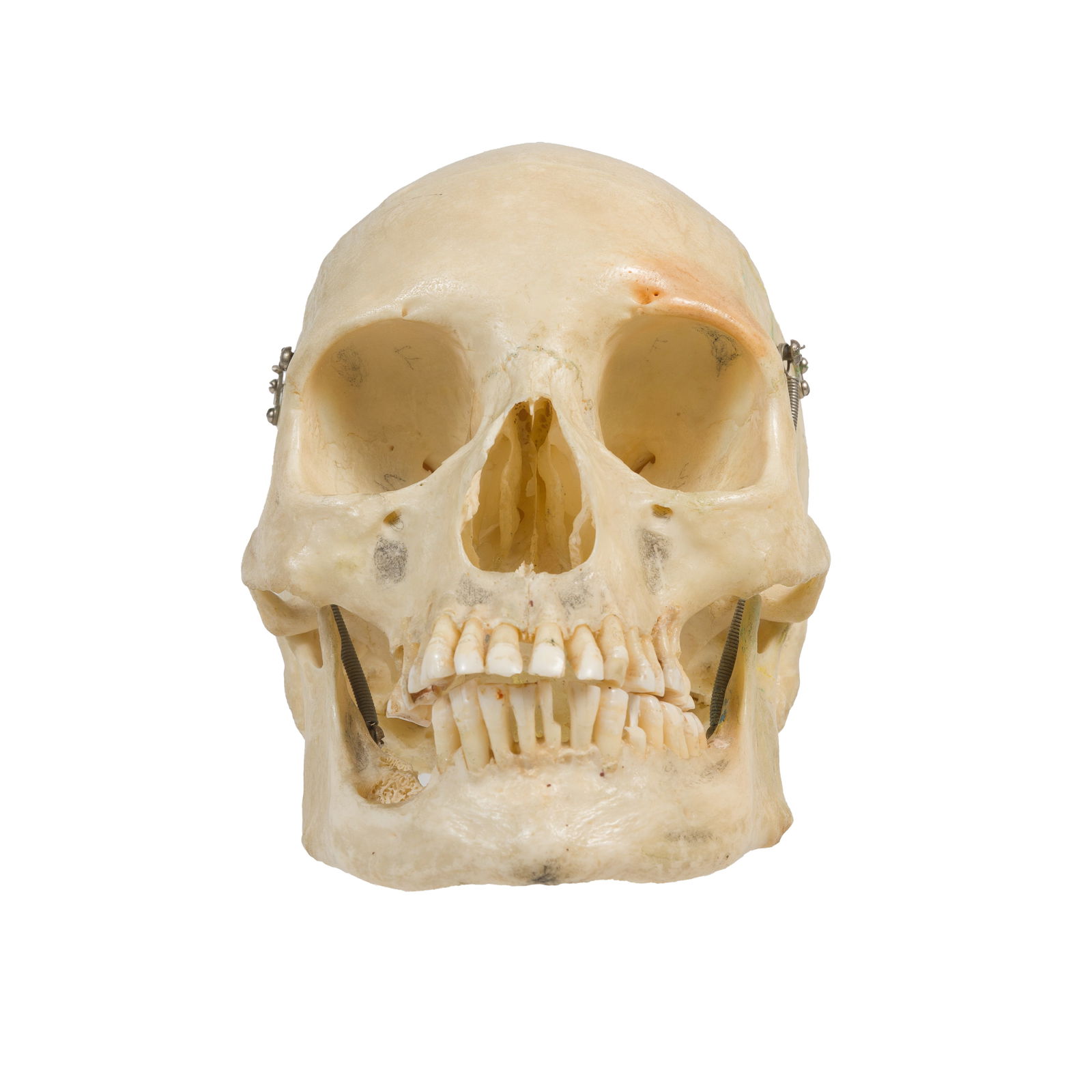 Clay-Adams Medical Skull: Clay-Adams Medical SkullArticulated Human Skull for Medical or Dental Study. Prepared by Clay Adams (New York). Hinged jaw and removable skull-cap. Stamped "Clay-Adams, New York, NY" on uppe