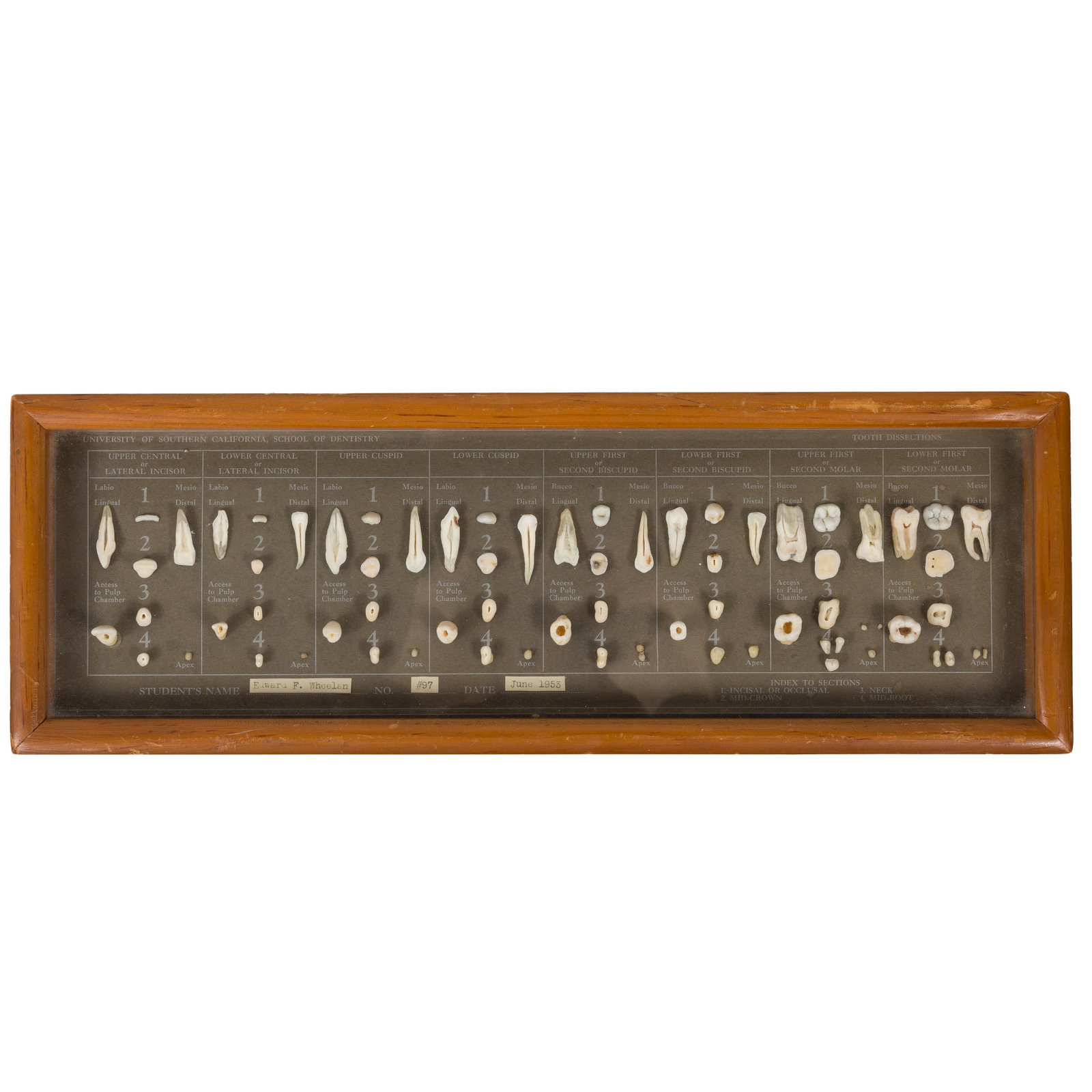 Tooth Dissection Examples: Tooth Dissection Examples Shadowbox framed mid-20th century student tooth dissection display. University of Southern California, School of Dentistry. By Edward F. Wheelen. June, 1953. 5.25"h x 15