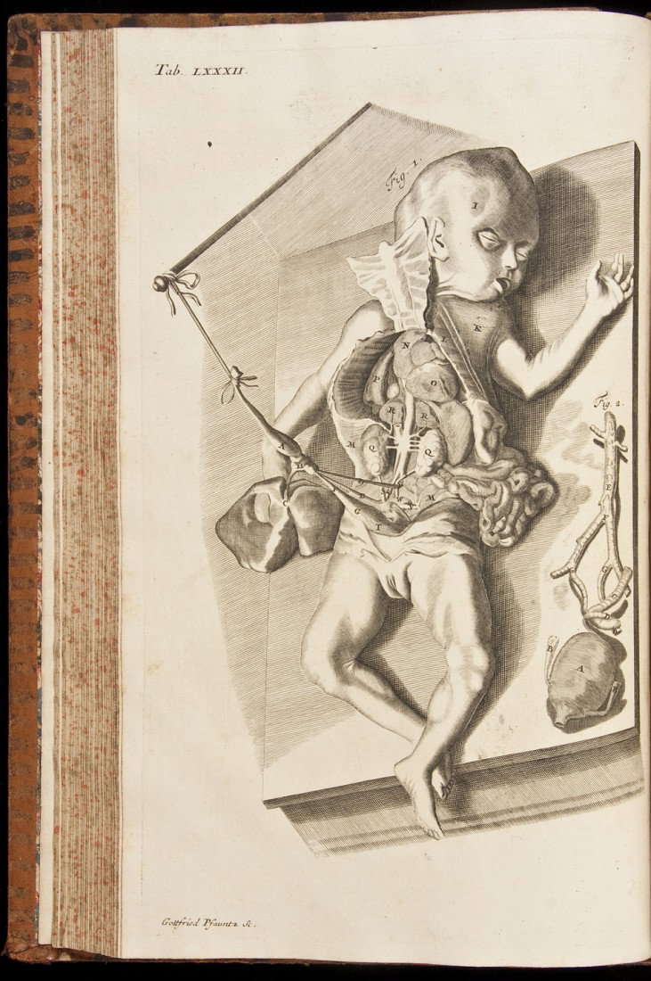 Theatrum Anatomicum by Manget 1717: Title: Theatrum Anatomicum Author: Manget, Jean Jacques Description: 2 volumes. [18], 434; [4], 452, [12], xvi, 34, [9] pp. Engraved portraits of Manget and Lancisi, plus 136 engraved plates, some fol