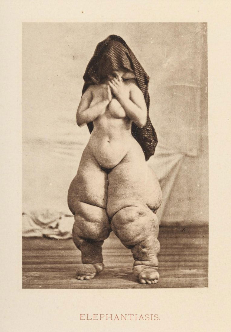 Photographs of Skin Diseases by Fox: Heading: Author: Fox, George Henry Title: Photographic Illustrations of Skin Diseases Place Published: New York Publisher:E.B. Treat Date Published: 1880 Description: [ii],