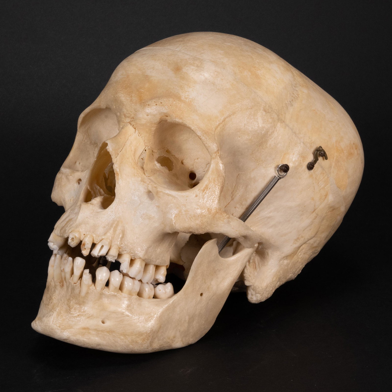 Antique Real Human Skull: Antique Real Human Skull Excellent Medical Dental Study Specimen Demo Demonstration Complete with Almost Full Dentition Teeth with Lower Jaw Movable by Metal Springs 8.25"L x 5.25" W x 6"H In Overall 