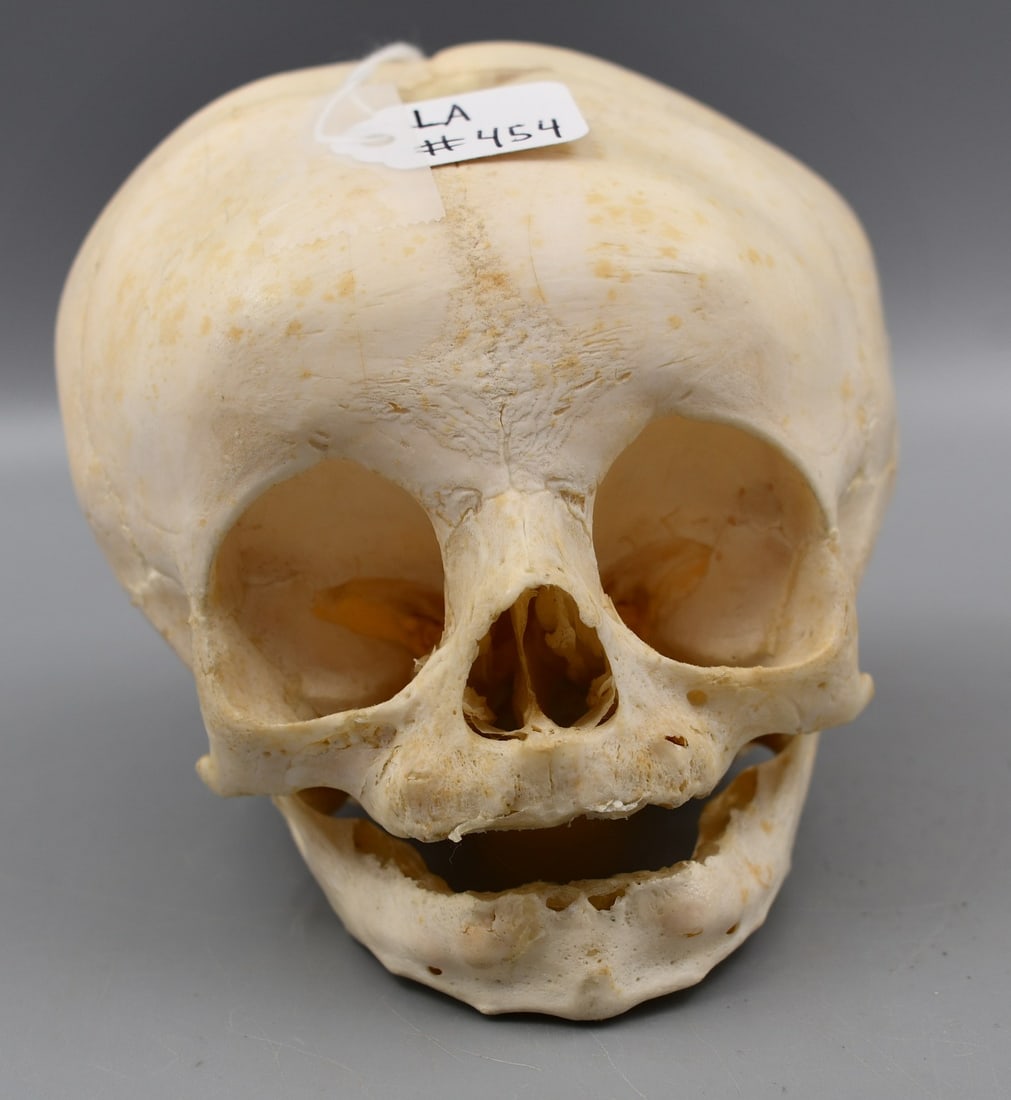 Human Child Skull: Human Child skull. Jaw bone is glued on. Soft spot of skull is visible. Underside of skull has traces of glue visible. (NOTE-Weight and dimensions are before packaging) Weight-2.7oz.