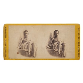 [CIVIL WAR] Footless and Emaciated POW Stereoview