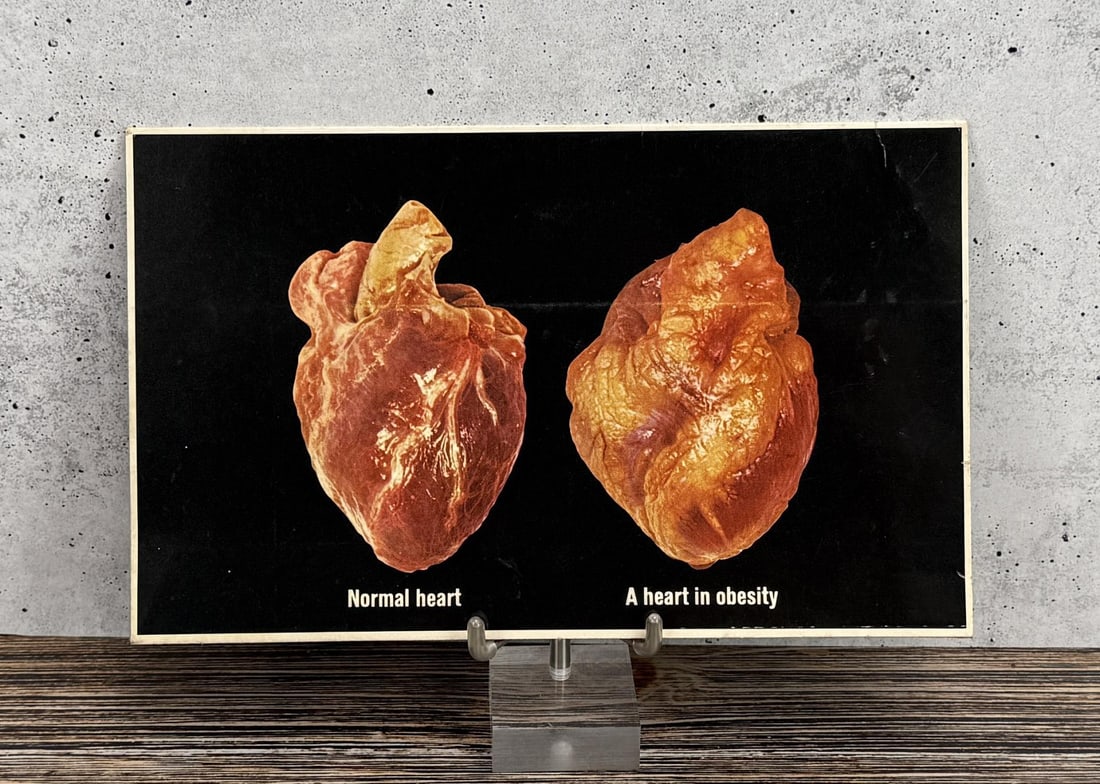 Graphic Enlarged Organs Doctor Visual Aids: Effect of obesity.