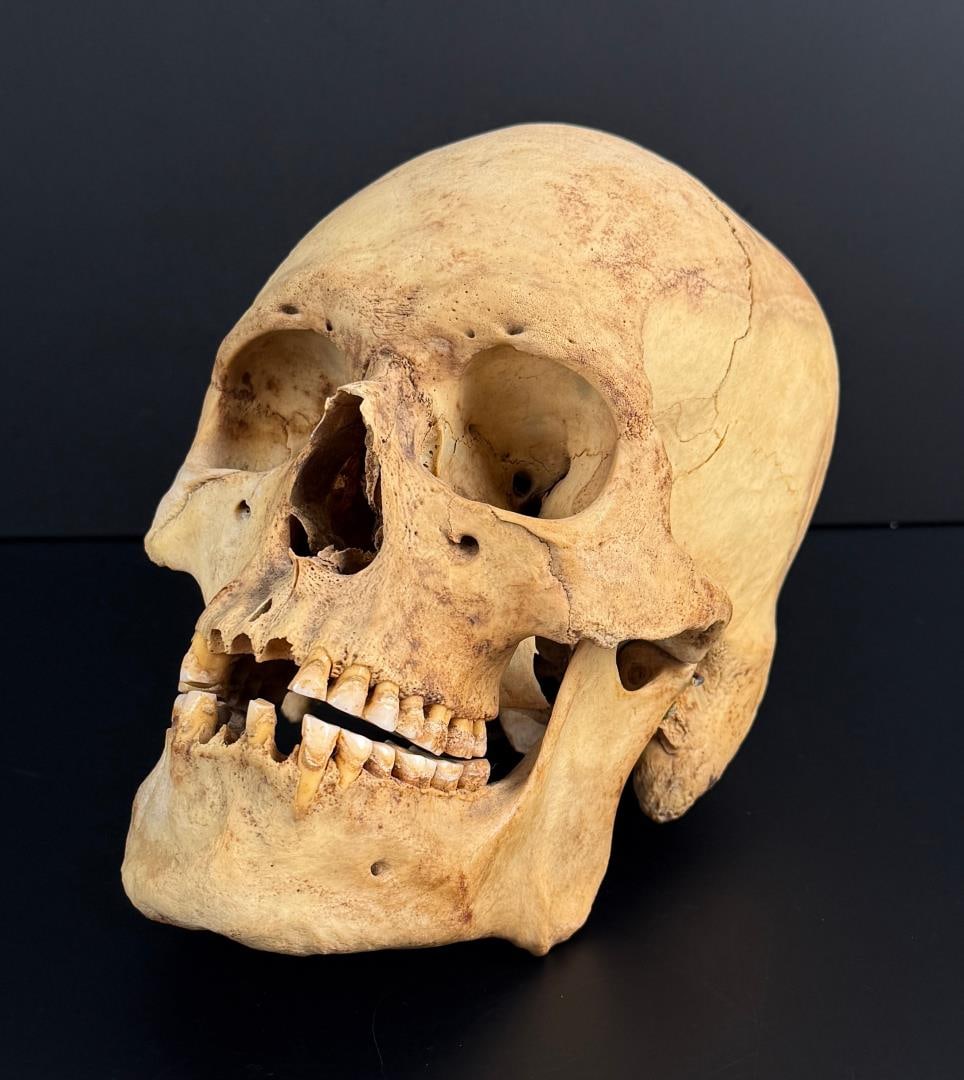 Antique Medical Male Human Skull West Eurasian: 9" by 6 1/8" by 5 1/4". Morphology suggests West Eurasian in ethnicity. No sales to Florida, Georgia, Louisiana, Massachusetts, Minnesota, Missouri, New Hampshire, South Carolina, Texas, Virginia. Any
