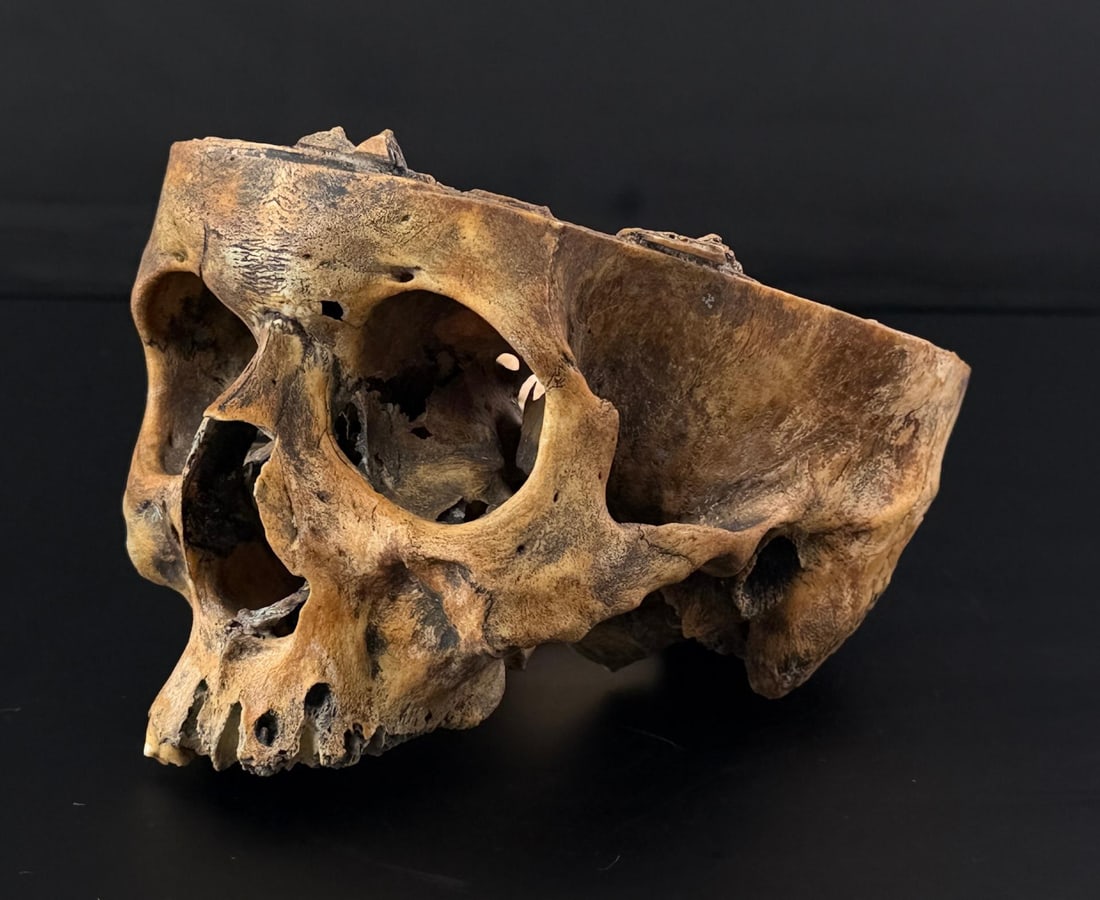 Antique Human Medical Autopsy Skull: Autopsy saw marks around the cranium, individual appears to have died from blunt force trauma to the back of the skull, a real colonel mustard in the library with the candlestick type of situation. 7 