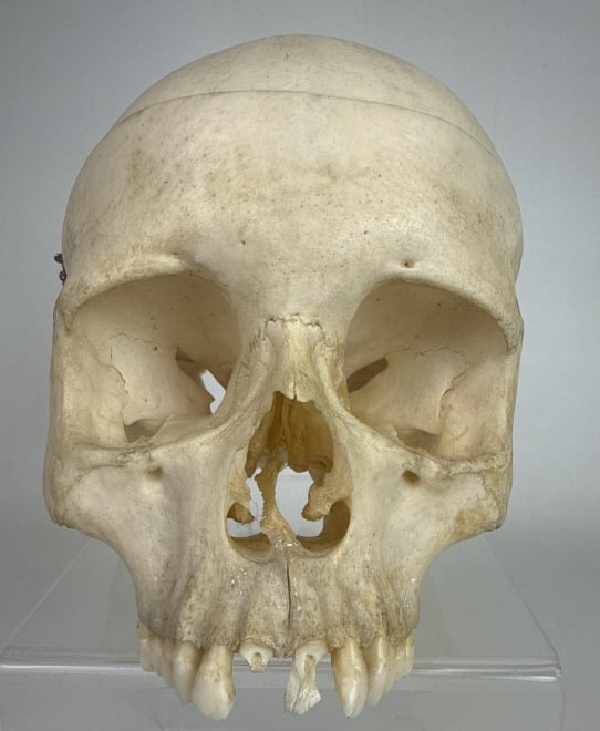 Human Skull Top Sawn Off Medical Specimen Missing Mandible. Big piece missing from back. (1 of 6)