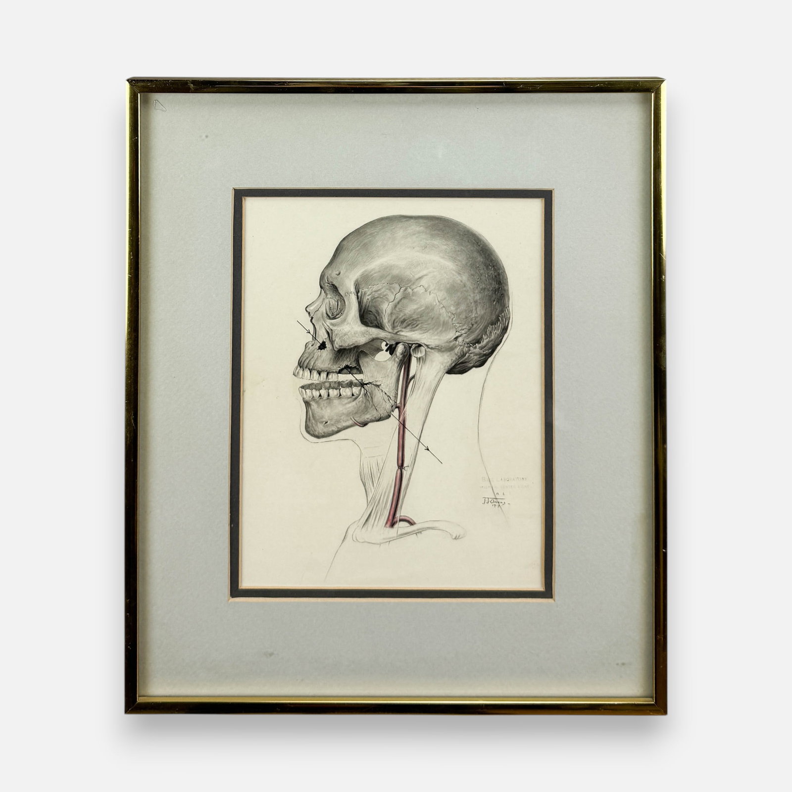 Original 1919 WWI Medical Injury Illustration Framed Drawing by J.J. Owens: Approx. sight size 9 1/4" x 7 1/4". For shipping, we highly recommend Donald Camden at UPS Store 4608. Alternatively, reach out to one of our preferred shippers listed at the link below or elect for L