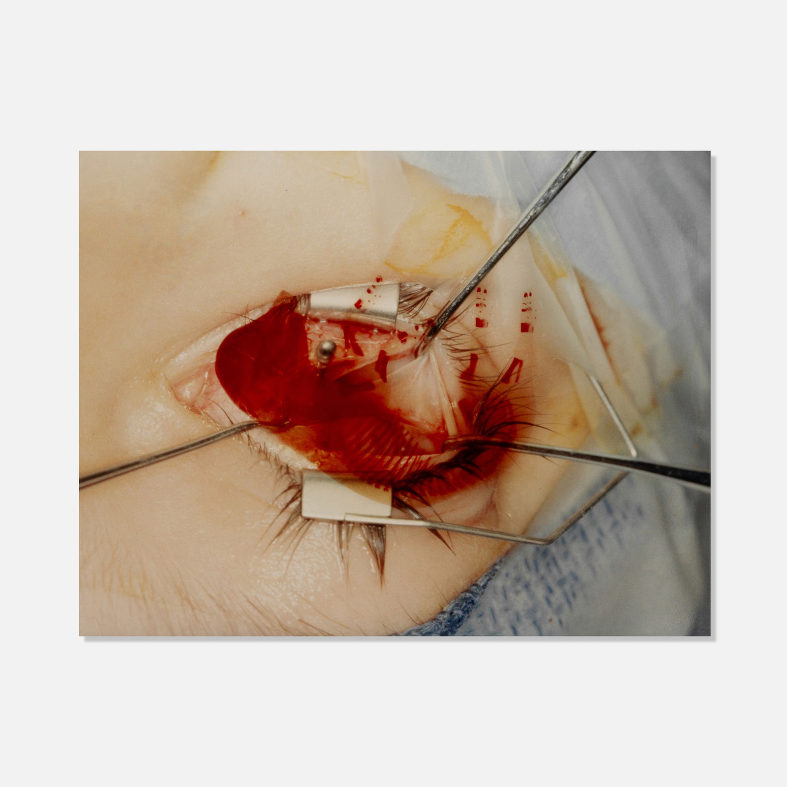 TODT, Untitled (Eye Surgery) (1 of 2)