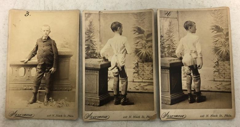 (3) CABINET CARDS BOY WITH PROSTHETIC LEG, ONE FULLY (1 of 6)