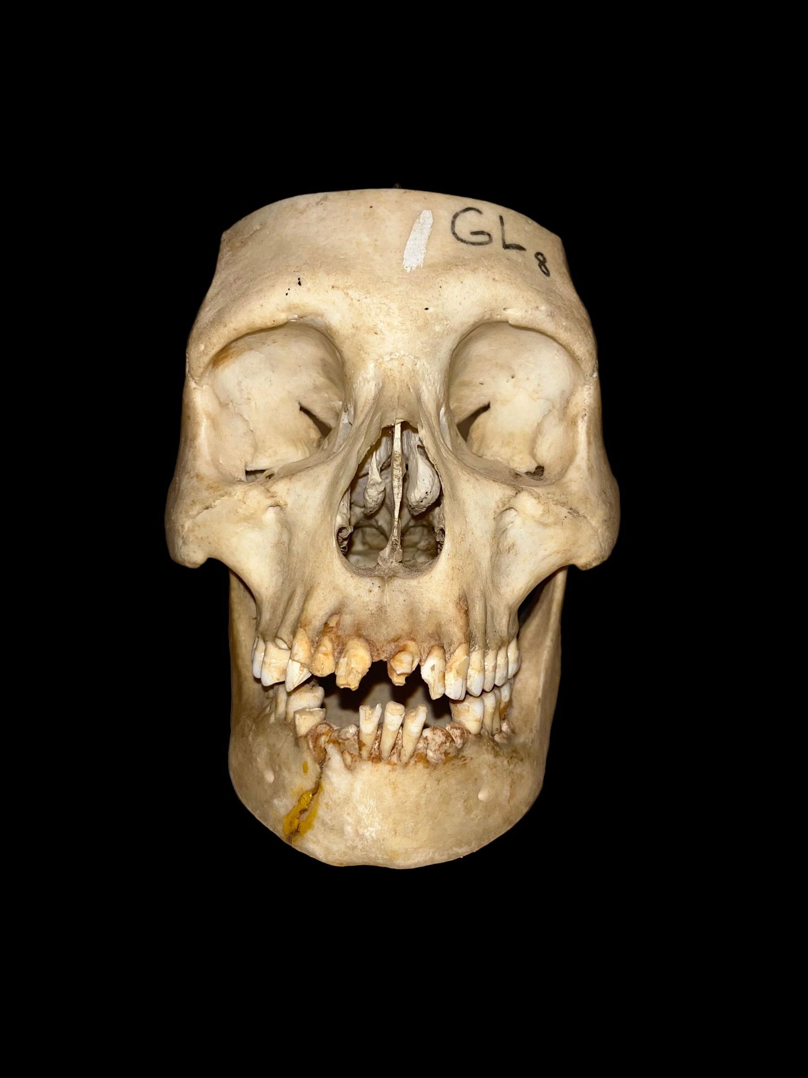 Antique Human Medical Skull With Mandible (1 of 7)
