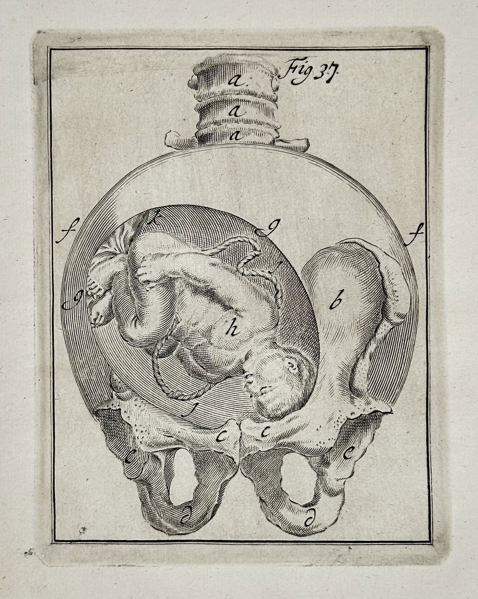 Hendrik van Deventer (1657–1724) – Anatomical Study of a Fetus in Transverse Presentation (1 of 3)