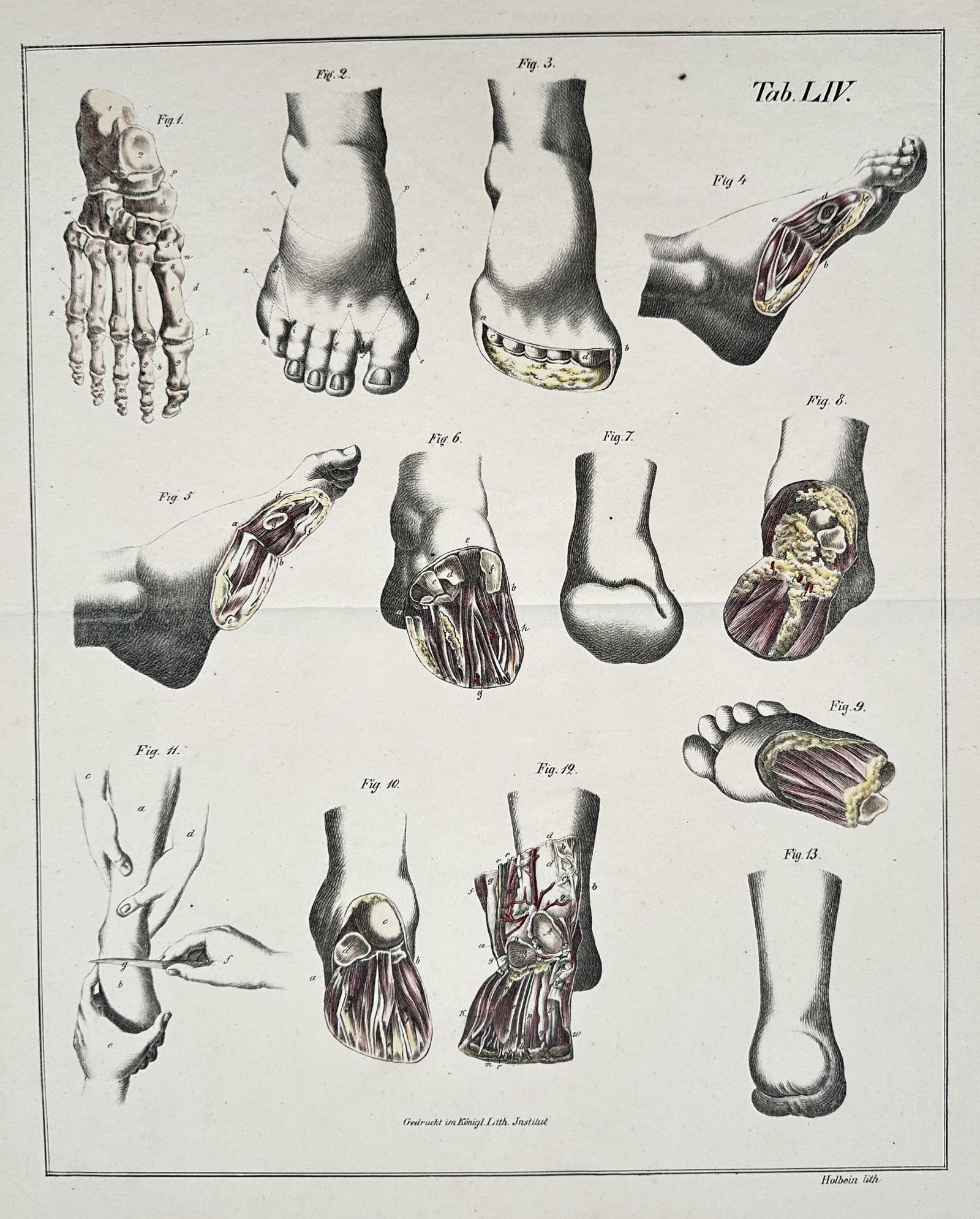 Claude Bernard (1813–1878) – Anatomical and Surgical Illustrations of the Foot (1 of 2)